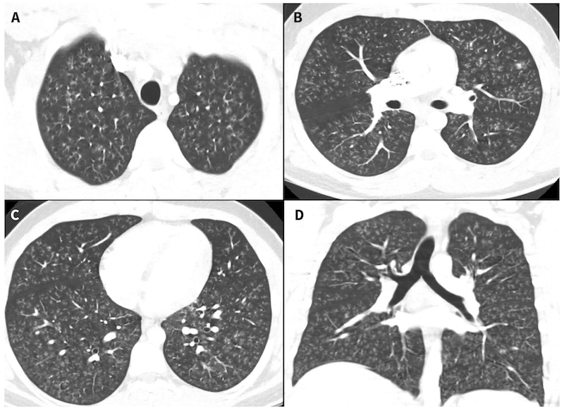 La tomografía computarizada del pecho del adolescente muestran varios nódulos asociados a la bronquiolitis constrictiva.Imagen: S. T. Landman et al., 2019/CMAJ